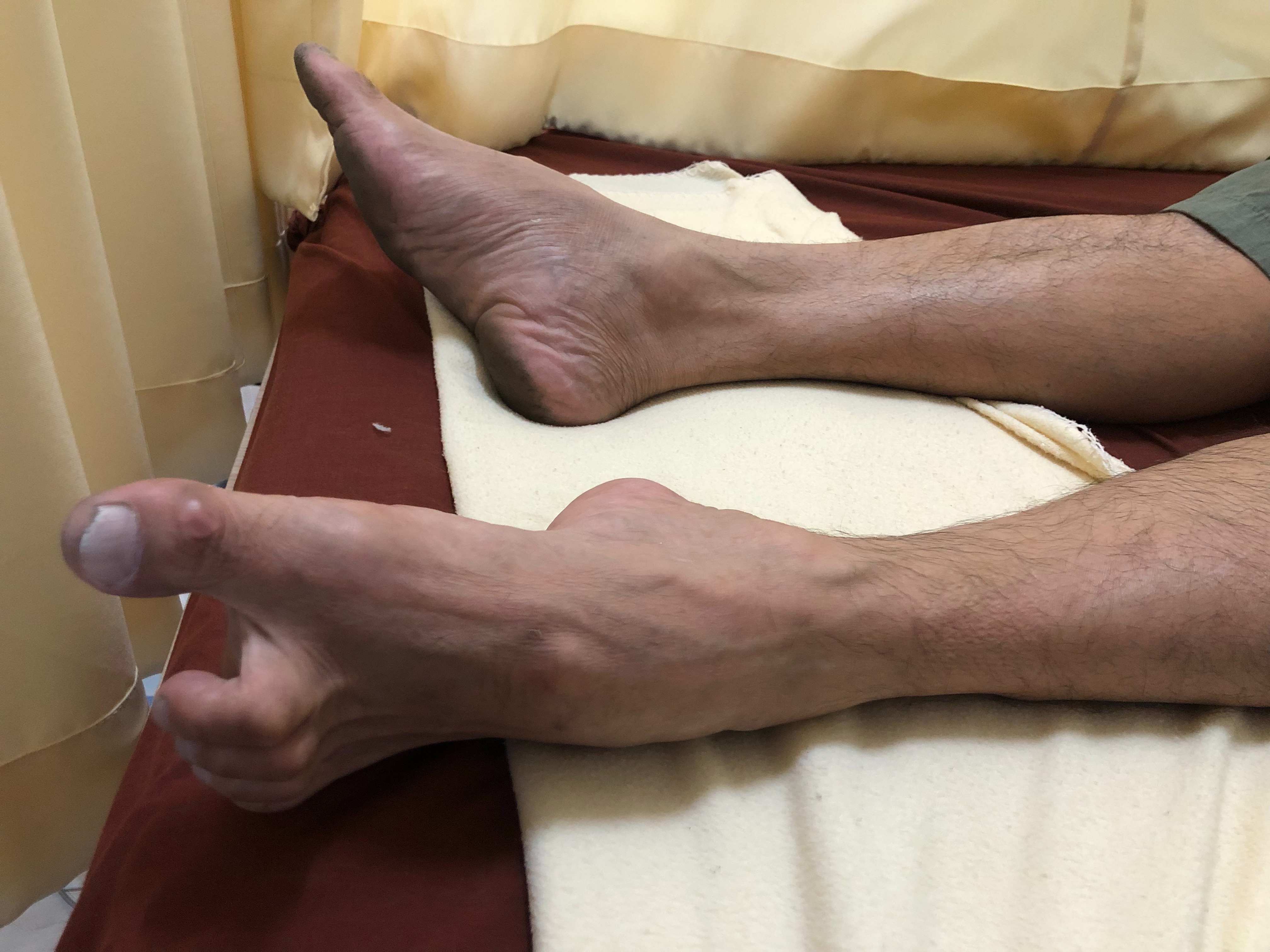 ดามกันปลายเท้าตกแบบปรับองศา (AFO Gait Assist) กันปลายเท้าตก เท้าแกว่ง ดามข้อเท้า ดามปลายเท้า ที่ประคองปลายเท้า