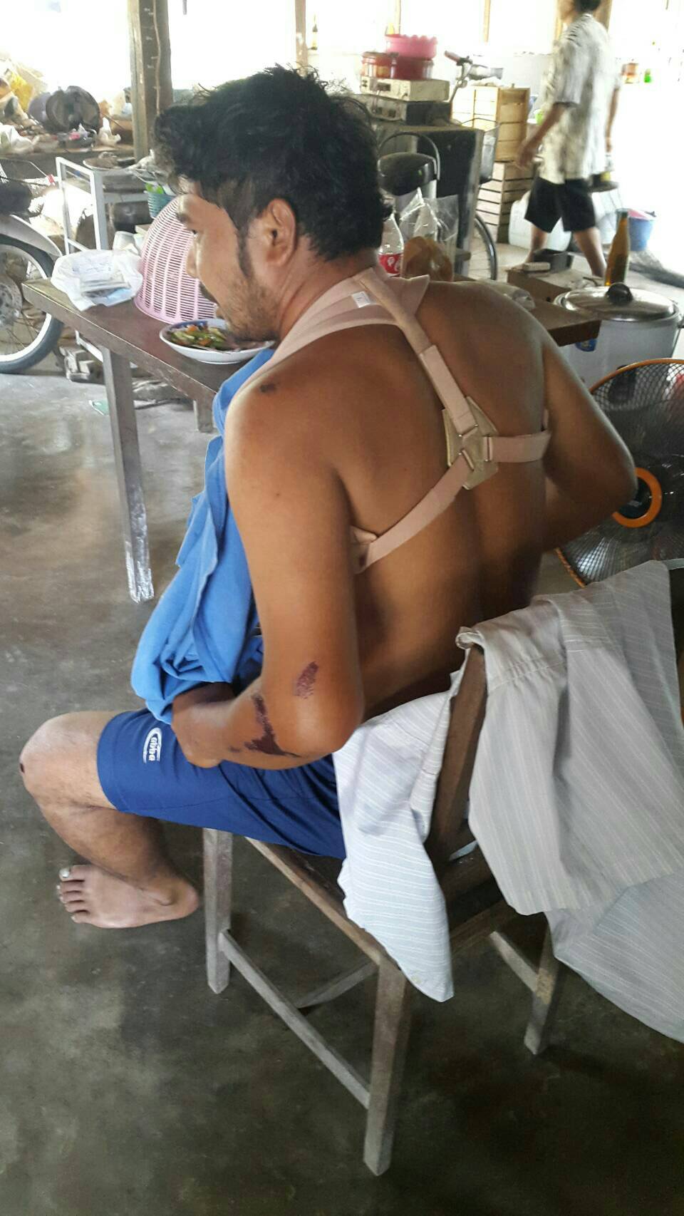 พยุงไหปลาร้า (Clavicle Splint) ชุดพยุงไหปลาร้า