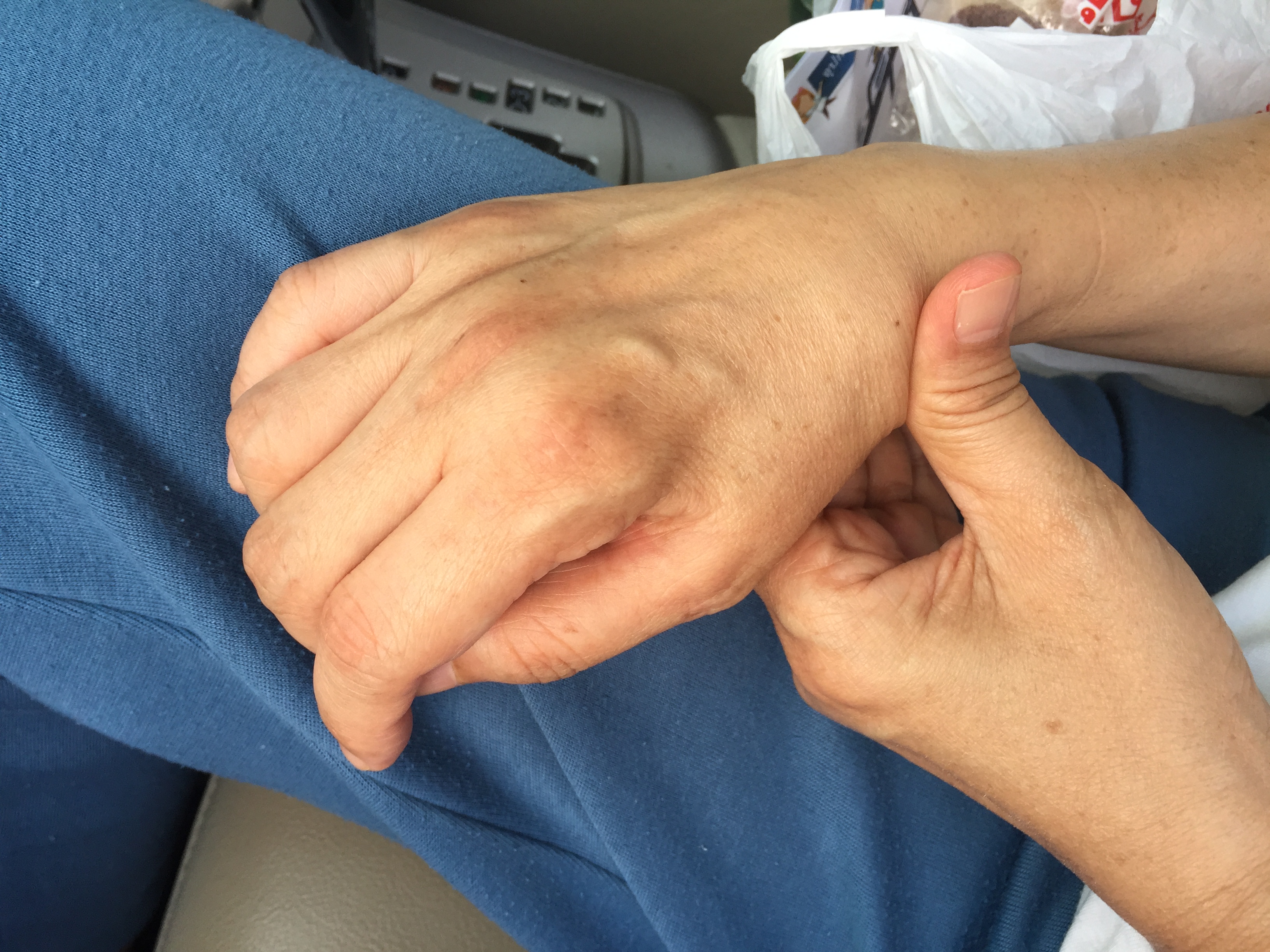 อุปกรณ์ดามกันนิ้วมืองอ /อุปกรณ์กายภาพนิ้ว/อุปกรณ์เหยียดนิ้วมือ/พลาสติกดามข้อมือ/palmar correction splint