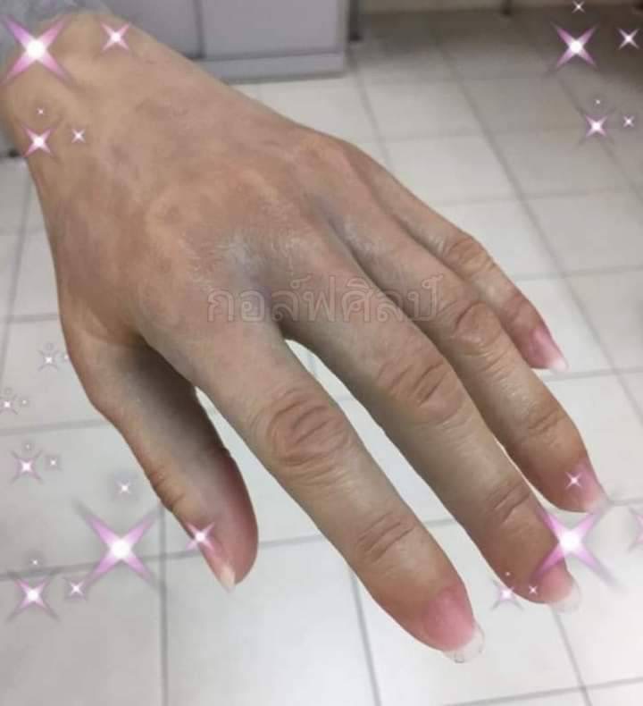 FIRSTPHYSIO/นิ้วมือเทียมเฉพาะบุคคล / ซิลิโคนนิ้วมือเทียมเฉพาะบุคคล