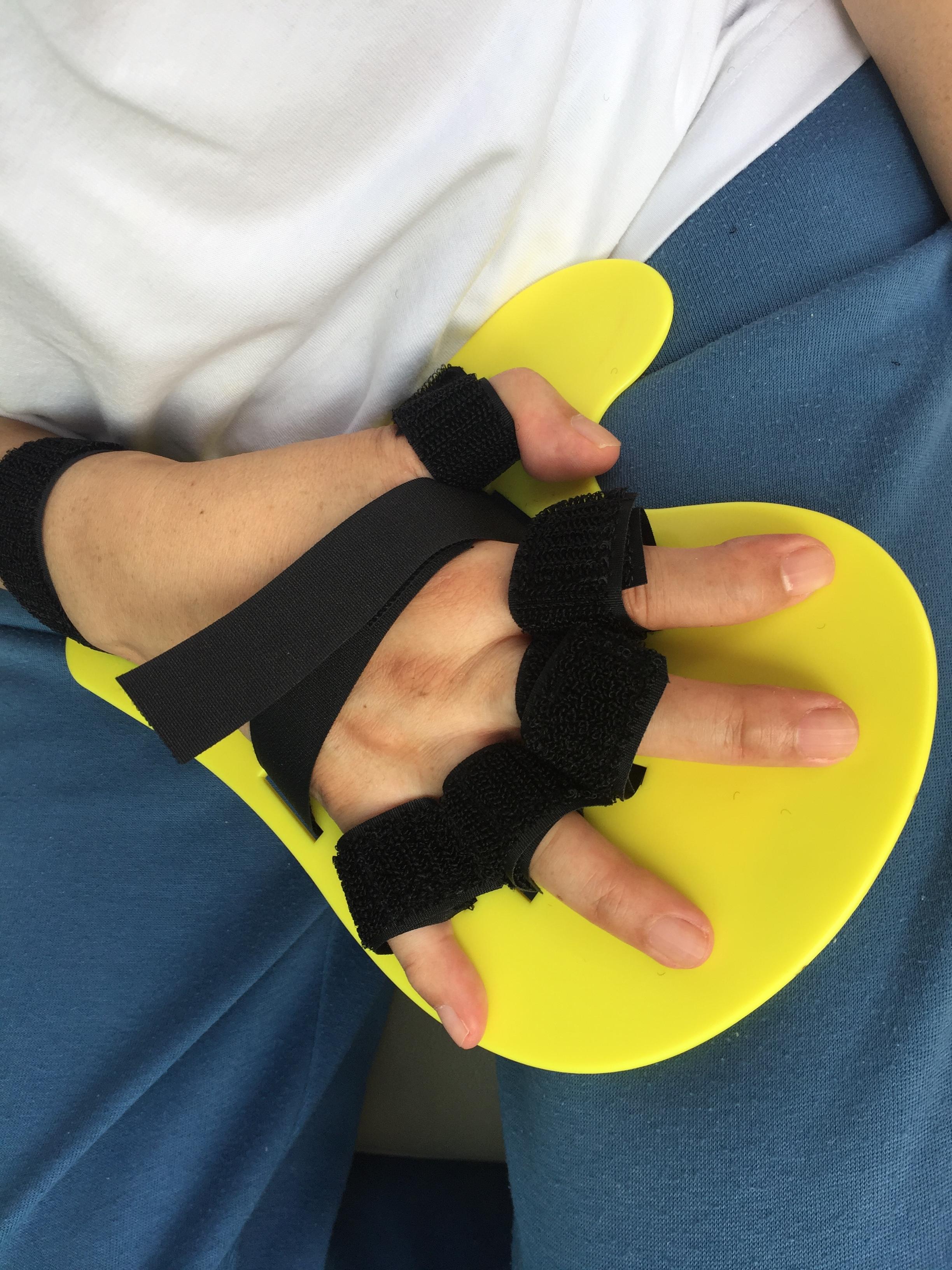 อุปกรณ์ดามกันนิ้วมืองอ /อุปกรณ์กายภาพนิ้ว/อุปกรณ์เหยียดนิ้วมือ/พลาสติกดามข้อมือ/palmar correction splint