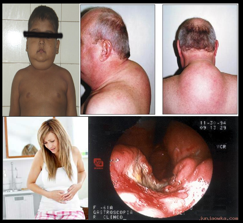 ผลเสียสเตียรอยด์, บวม, กระเพาะทะลุ, โหนก