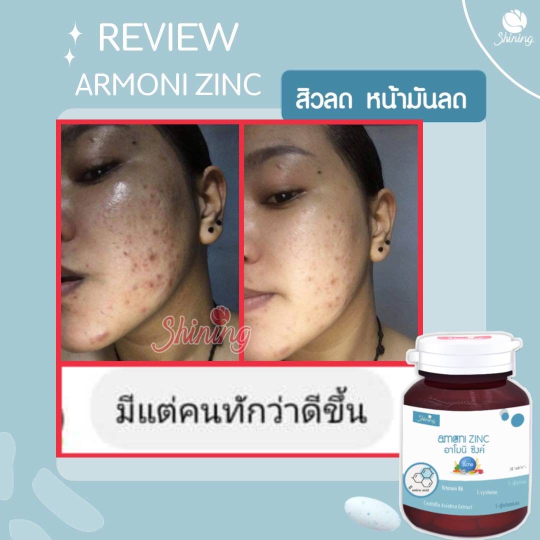 อาโมนิซิงค์ (Armoni Zinc) ชายนิ่ง ลดสิว เพิ่มภูมิ ผิวขาวใส ผมแข็งแรง // ของแท้100%
