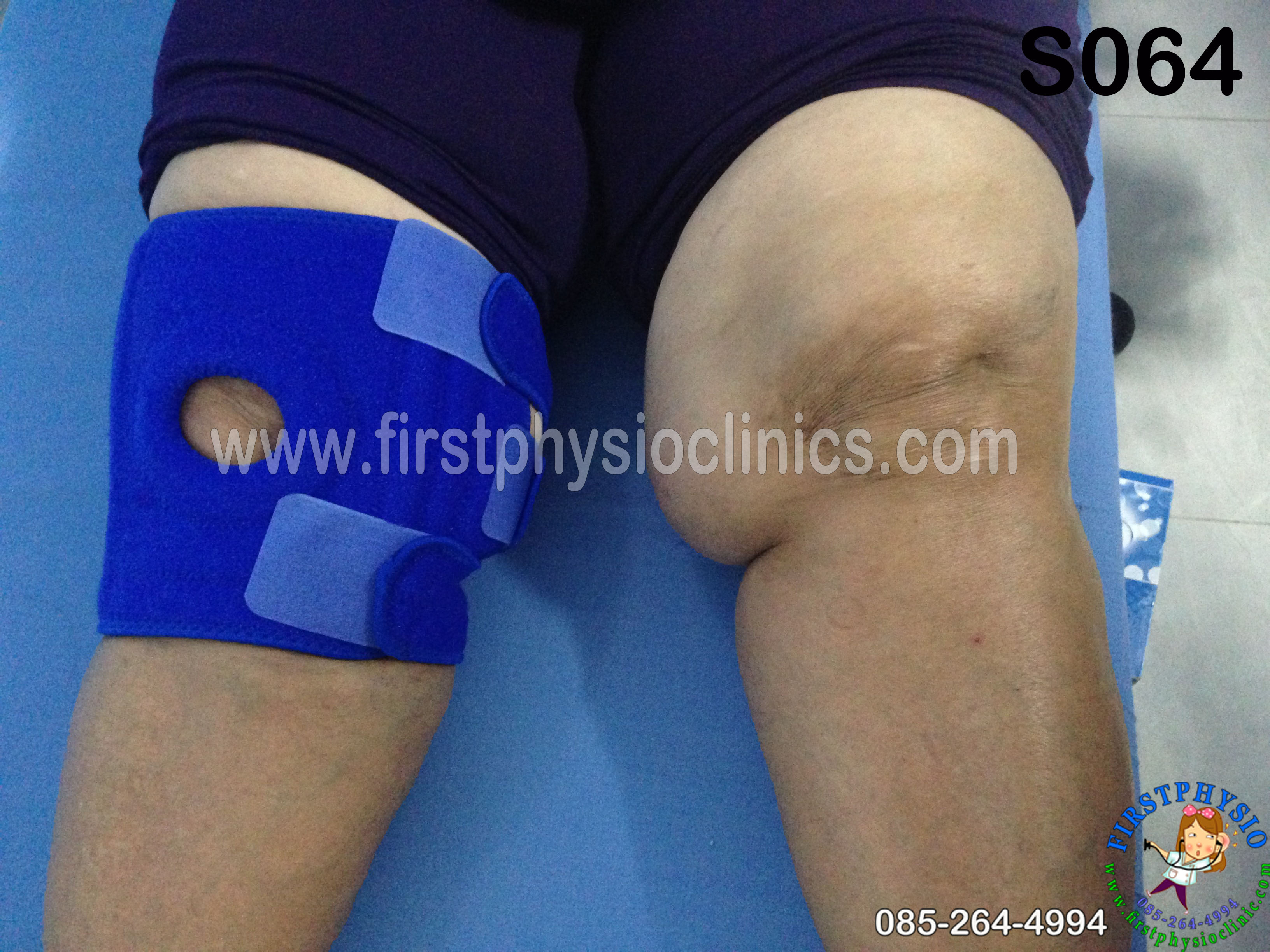 อุปกรณ์พยุงข้อเข่าสำหรับคนอ้วนมาก (Knee obesity)
