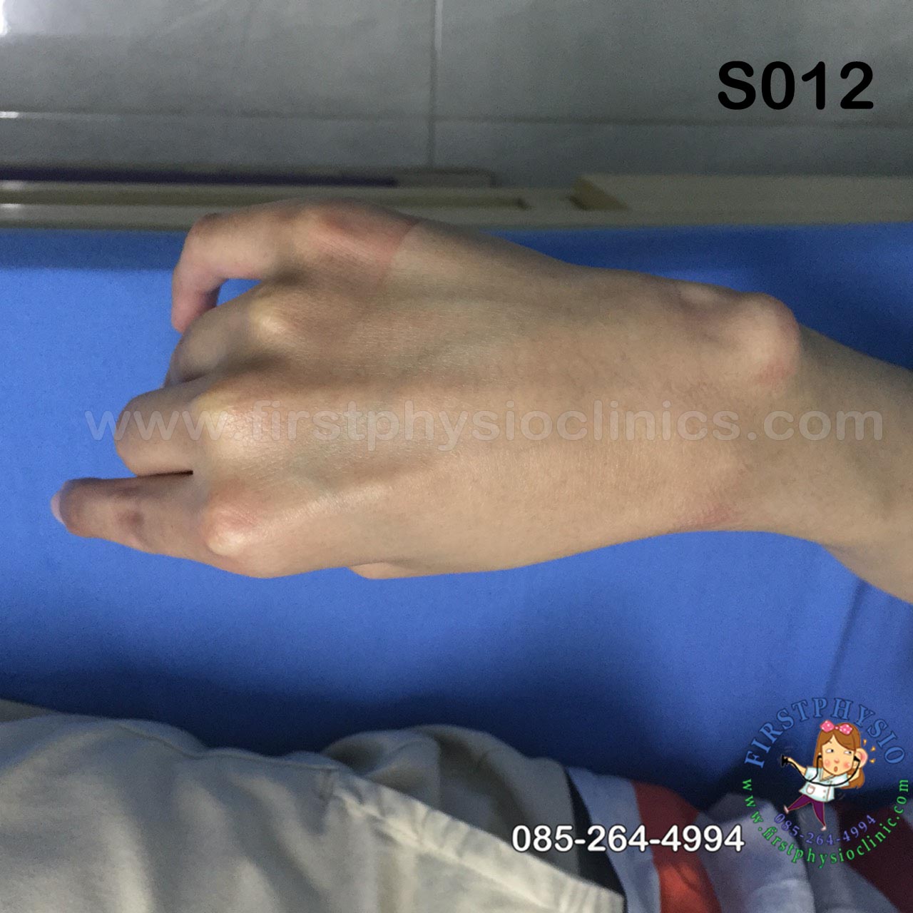 อุปกรณ์ดามกันนิ้วมืองอ /อุปกรณ์กายภาพนิ้ว/อุปกรณ์เหยียดนิ้วมือ/พลาสติกดามข้อมือ/palmar correction splint