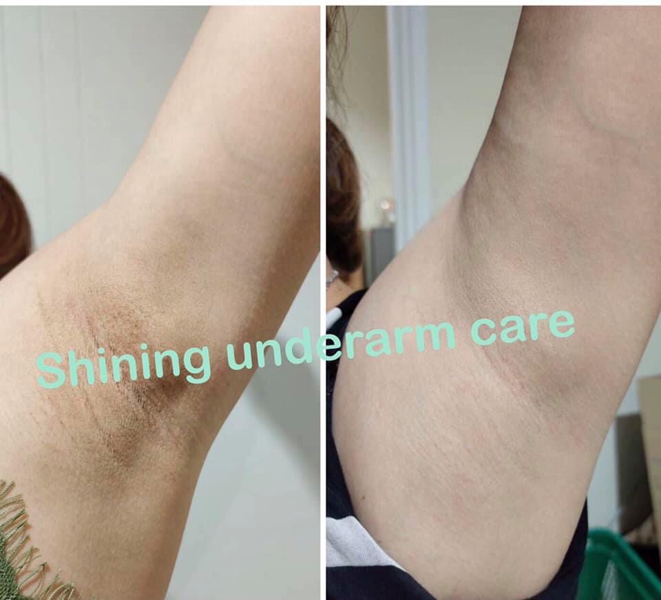 SHINING UNDERARM CARE CREAM ครีมทารักแร้ ก้น ขาหนีบ ข้อศอก หัวเข่า ลดตุ่มหนังไก่ ระงับกลิ่นกาย