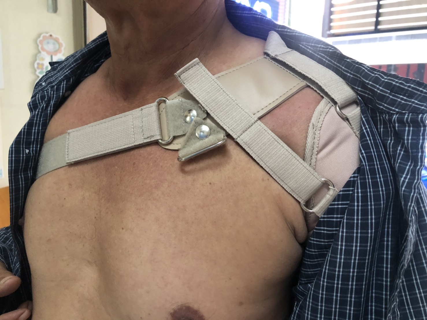 พยุงข้อไหล่หลวม พยุงไหล่ ที่พยุงไหล่ สายรัดพยุงไหล่ปรับได้ ประคองหัวไหล่ สายรัดไหล่ สายรัดพยุงไหล่ shoulder support Bobath Sling