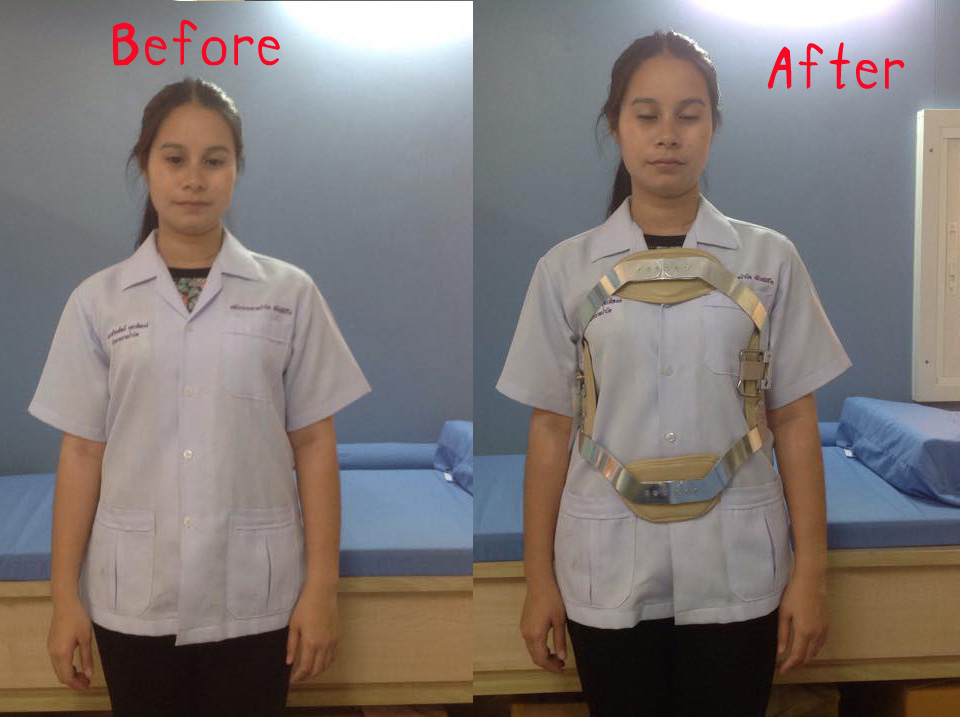 พยุงหลังโครงเหล็กด้านหน้า เจเวท พยุงลำตัวกระดูกทรุด ป้องกันการโค้งงอของหลังมาด้านหน้า,ด้านหลัง,ด้านข้าง Jewett Brace