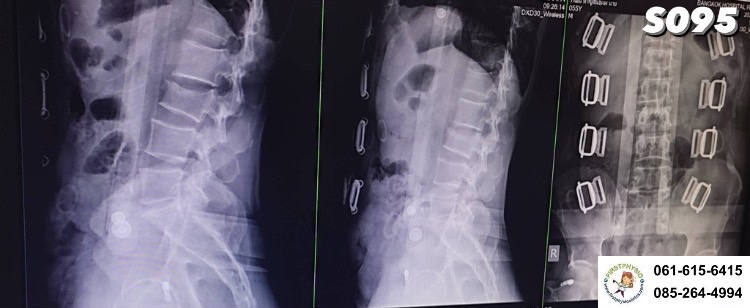 FIRSTPHYSIO/เสื้อเฝือกพยุงกระดูกสันหลัง / SPINAL BRACE