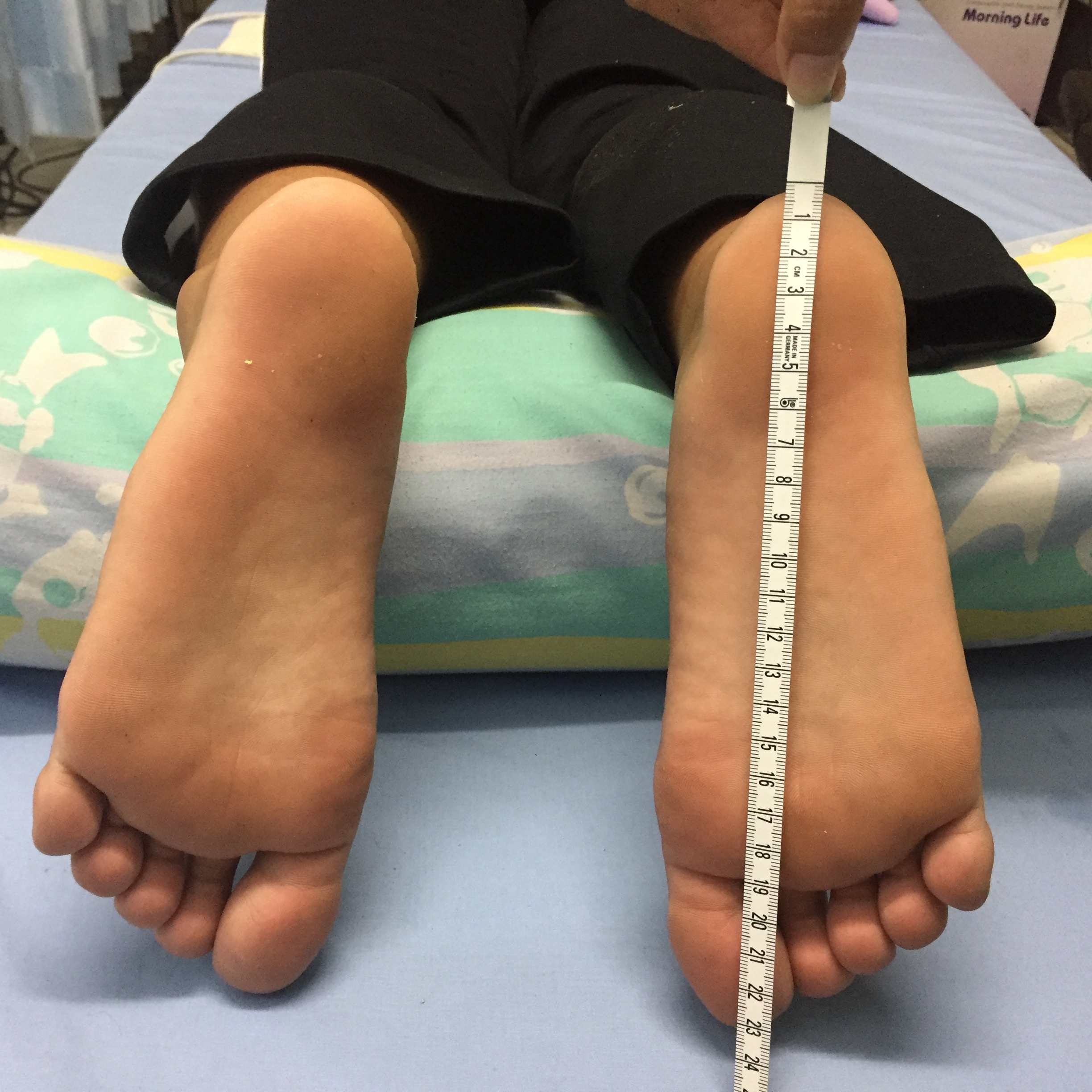 รองเท้าเฝือกลม (Air Cast)/รองเท้าสำหรับคนกระดูกเท้าแตกแบบมีปั๊มลมแบบยาว /รองเท้าปั๊มลม/เฝือกปั็มลม