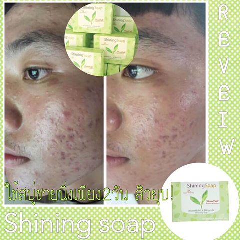 สบู่ชายนิ่ง สบู่จากสเต็มเซลล์พืช ธรรมชาติล้วนๆ ลดสิวได้ทั้งผิวหน้าและผิวกาย