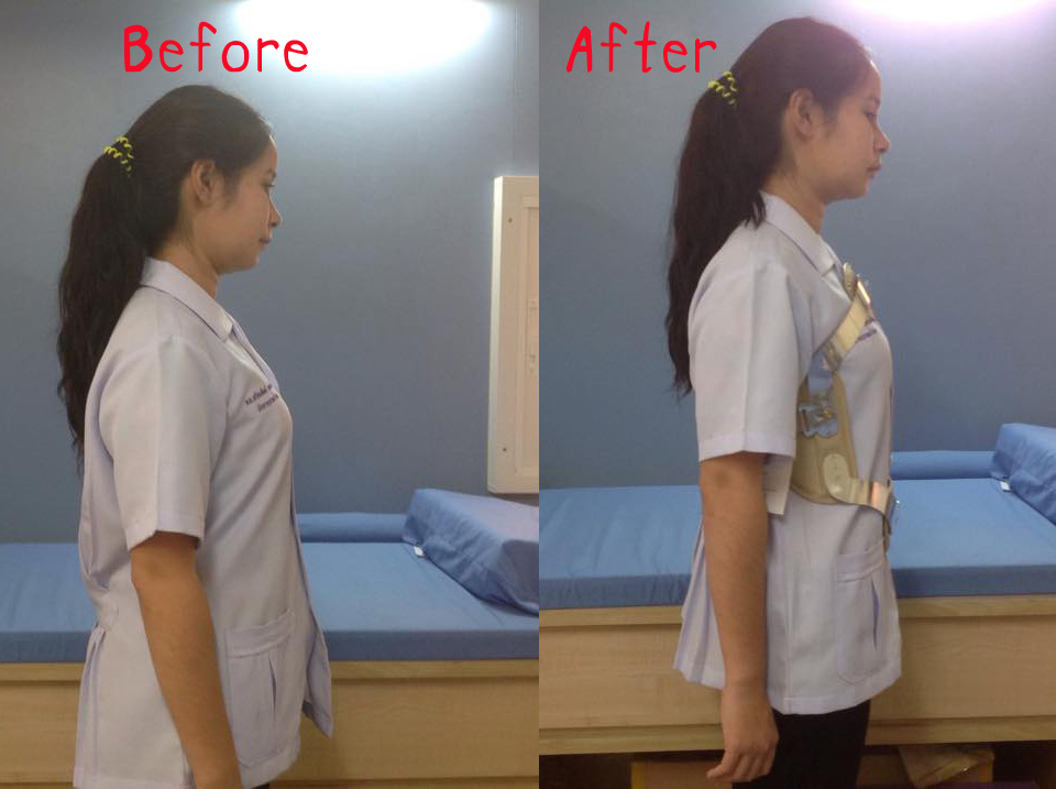 พยุงหลังโครงเหล็กด้านหน้า เจเวท พยุงลำตัวกระดูกทรุด ป้องกันการโค้งงอของหลังมาด้านหน้า,ด้านหลัง,ด้านข้าง Jewett Brace