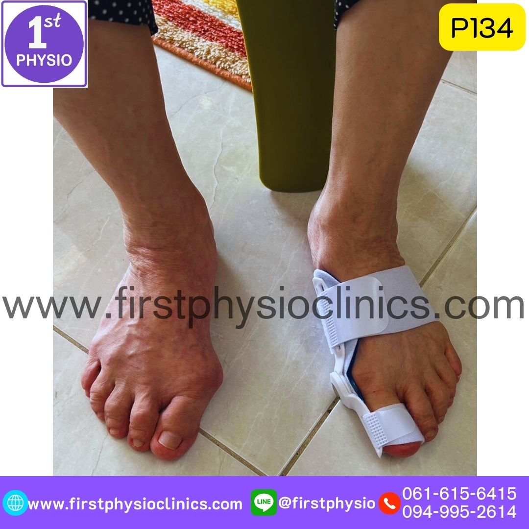 ที่ดามกันนิ้วหัวแม่เท้าเอียง/ที่ดามกันนิ้วโป้งเท้าเอียง/อุปกรณ์ดามนิ้วเท้าเก/อุปกรณ์แก้เท้าผิดรูป