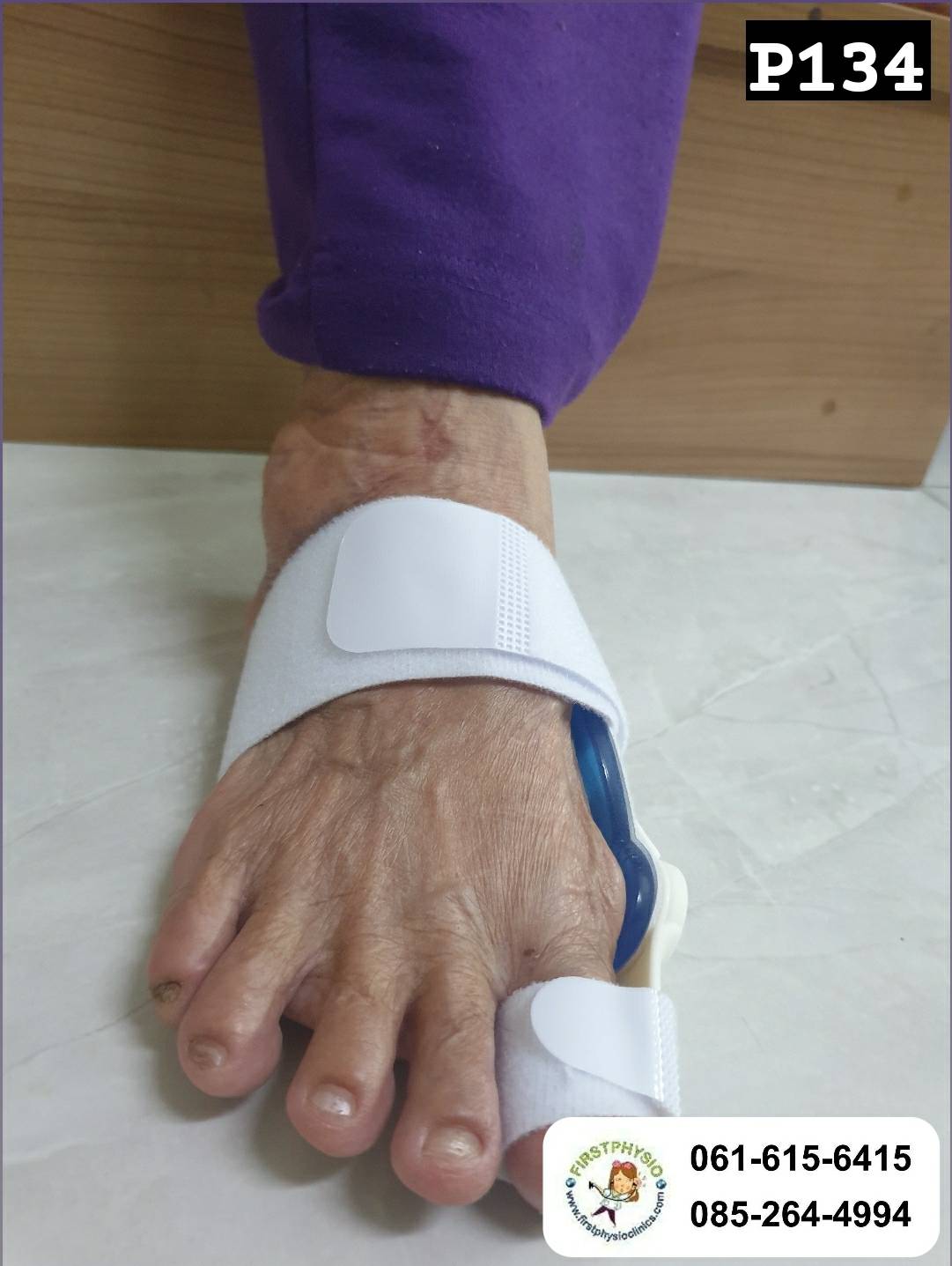 ที่ดามกันนิ้วหัวแม่เท้าเอียง/ที่ดามกันนิ้วโป้งเท้าเอียง/อุปกรณ์ดามนิ้วเท้าเก/อุปกรณ์แก้เท้าผิดรูป