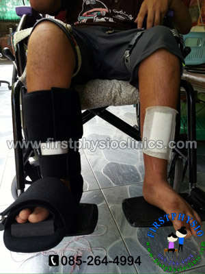 อุปกรณ์ดามกันเท้าตกแบบ 90 องศา อุปกรณ์ดามกันเท้าตก [#1 AFO 90]