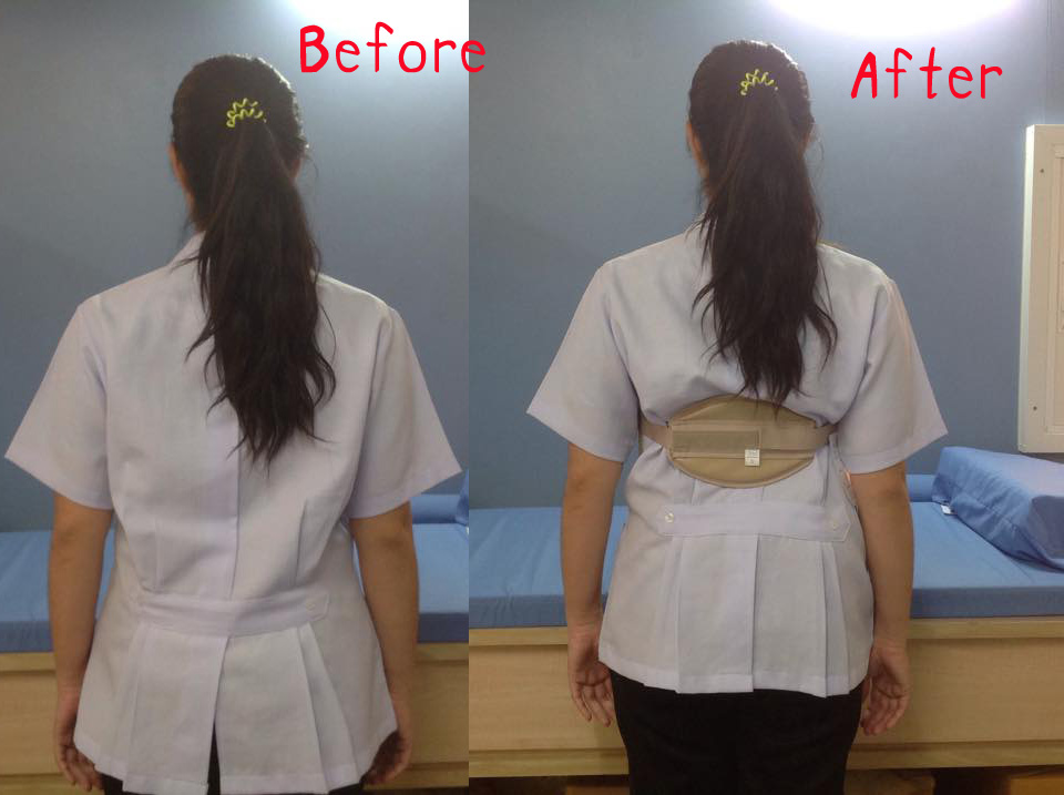 พยุงหลังโครงเหล็กด้านหน้า เจเวท พยุงลำตัวกระดูกทรุด ป้องกันการโค้งงอของหลังมาด้านหน้า,ด้านหลัง,ด้านข้าง Jewett Brace