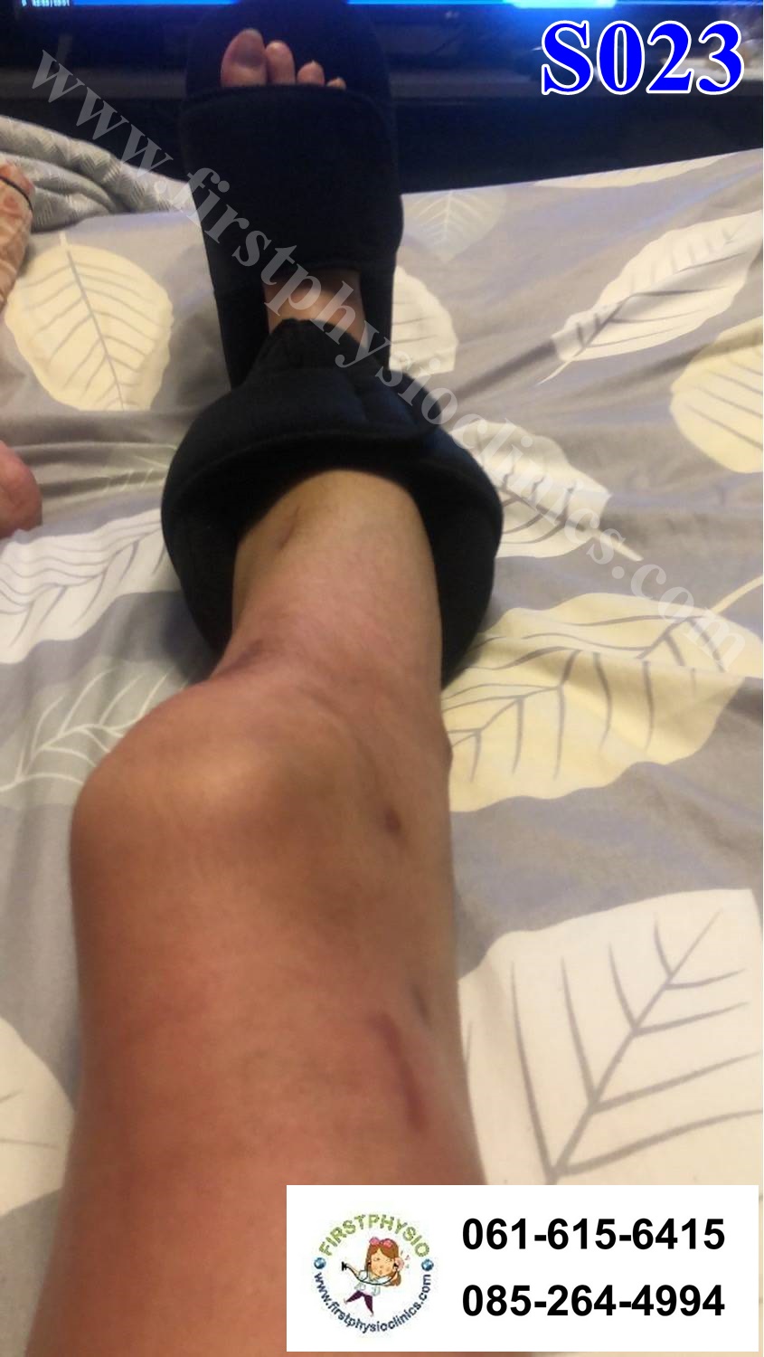 อุปกรณ์ดามกันเท้าตกแบบ 90 องศา อุปกรณ์ดามกันเท้าตก [#1 AFO 90]