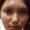 รักษาสิวด้วยครีมสเตียรอยด์ อันตราย???