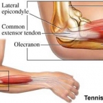 ตอนที่3 : โรค Tennis elbow
