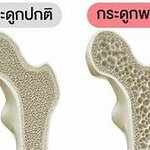 ตอนที่ 385 ทำความเข้าใจโรคกระดูกพรุน: สาเหตุ อาการ และทางเลือกในการรักษา