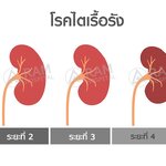 ตอนที่ 399 โรคไต มีกี่ระยะ?