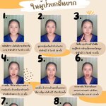 ตอนที่ 295 การบริหารกล้ามเนื้อปากและลิ้น ในผู้ป่วยกลืนยาก