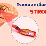ตอนที่ 390 โรคหลอดเลือดสมอง : คืออะไร อาการ อาการแสดง สาเหตุ